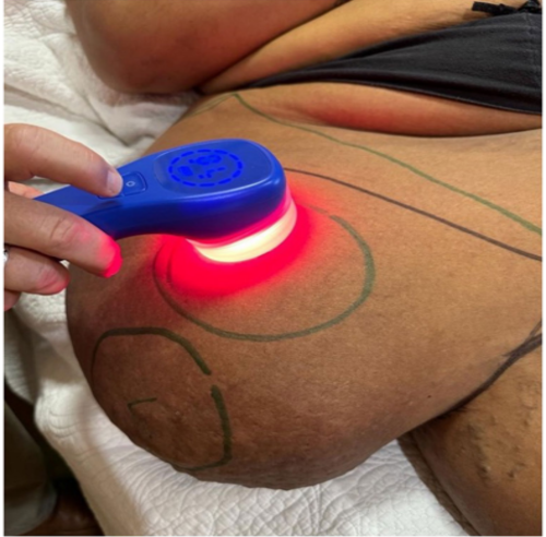 Lipedema: novo estudo revela efeitos da fotobiomodulação no tratamento